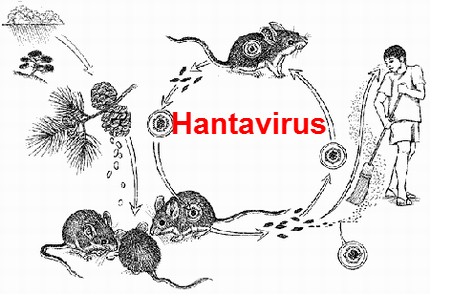 Hantavirus Pulmonary Syndrome